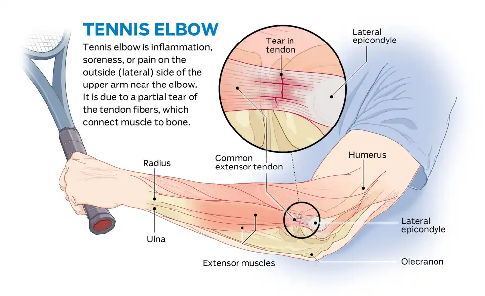 Tennis elbow Treatment